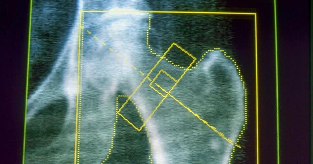 New Study Links GLP-1 Medications to Osteoporosis and Gout Risks - GLP-1s May Increase Risk Of Osteoporosis And Gout, New Research Finds