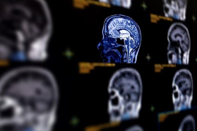 AI Shows Promise in Predicting Alzheimer's with High Accuracy - Researchers Say AI Can Predict Alzheimer’s Disease With Close To 93 Percent Accuracy