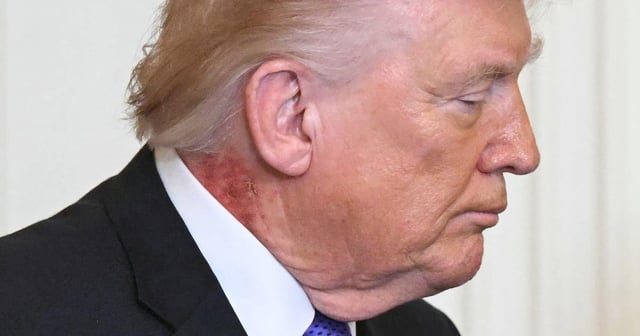 Trump's New Skin Condition Raises Health Concerns - Trump, 79, Displays Worrying New Skin Condition